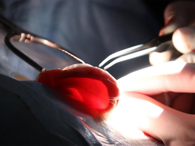 El Hospital Universitario de Torrejón de Ardoz realiza con éxito su primer implante coclear para mejorar la audición